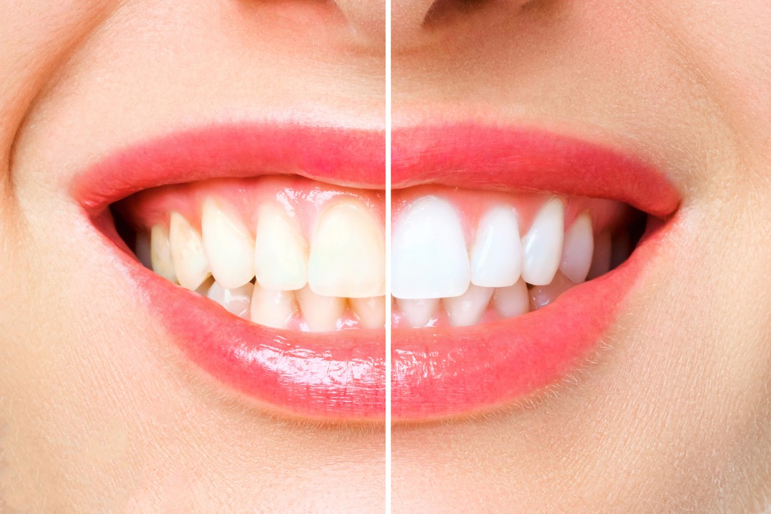 すてきな白い歯に！歯のホワイトニングができる歯医者さん＆ケアサロン | Pathee(パシー)